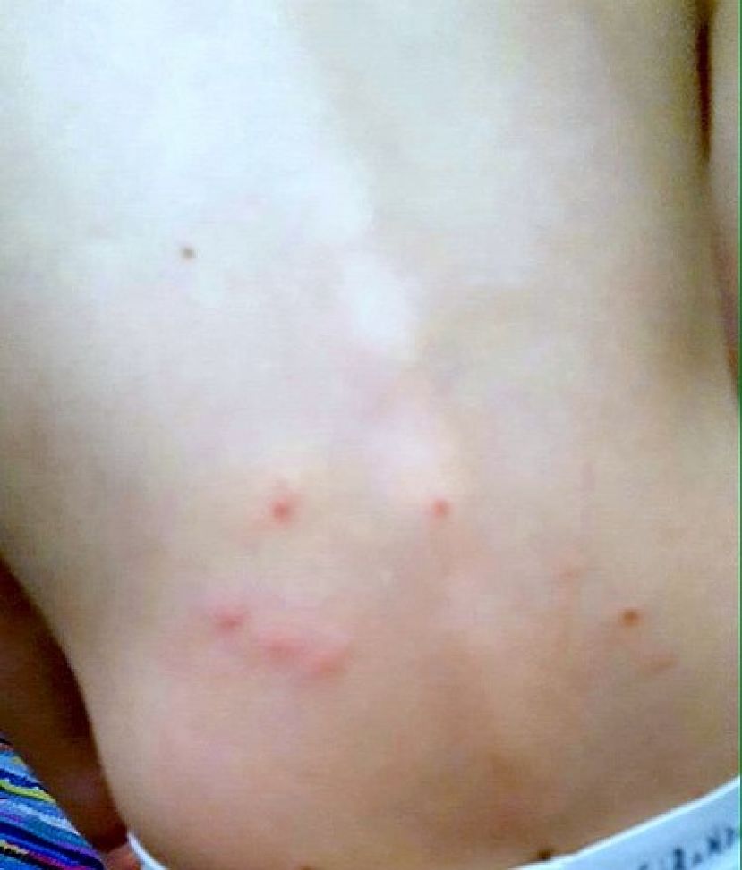 Telde: Usuarios del parque de San Gregorio denuncian la presencia de pulgas